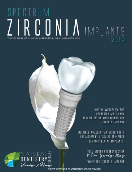 Spectrum Zirconia Implants 2019