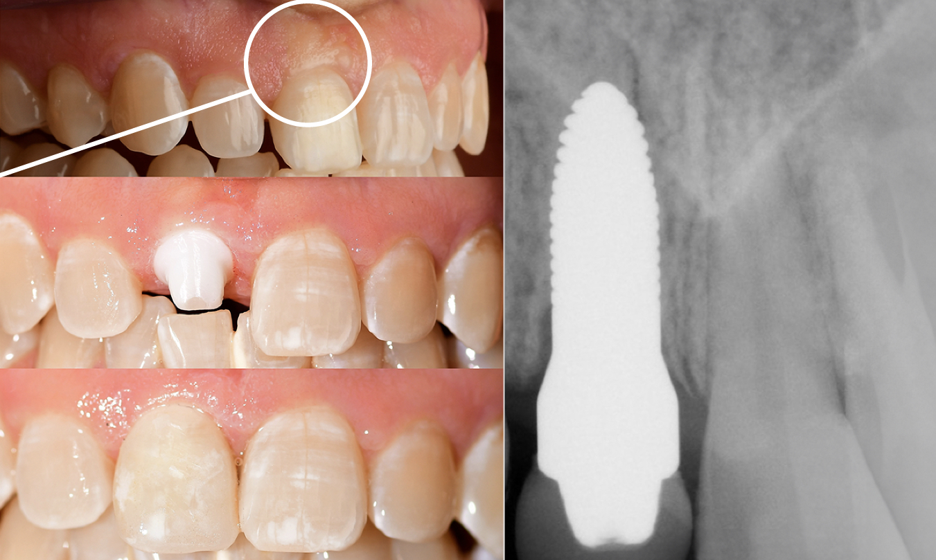Holistic alternatives to root canals biological extraction and zirconia implant by Dr. May Connecticut