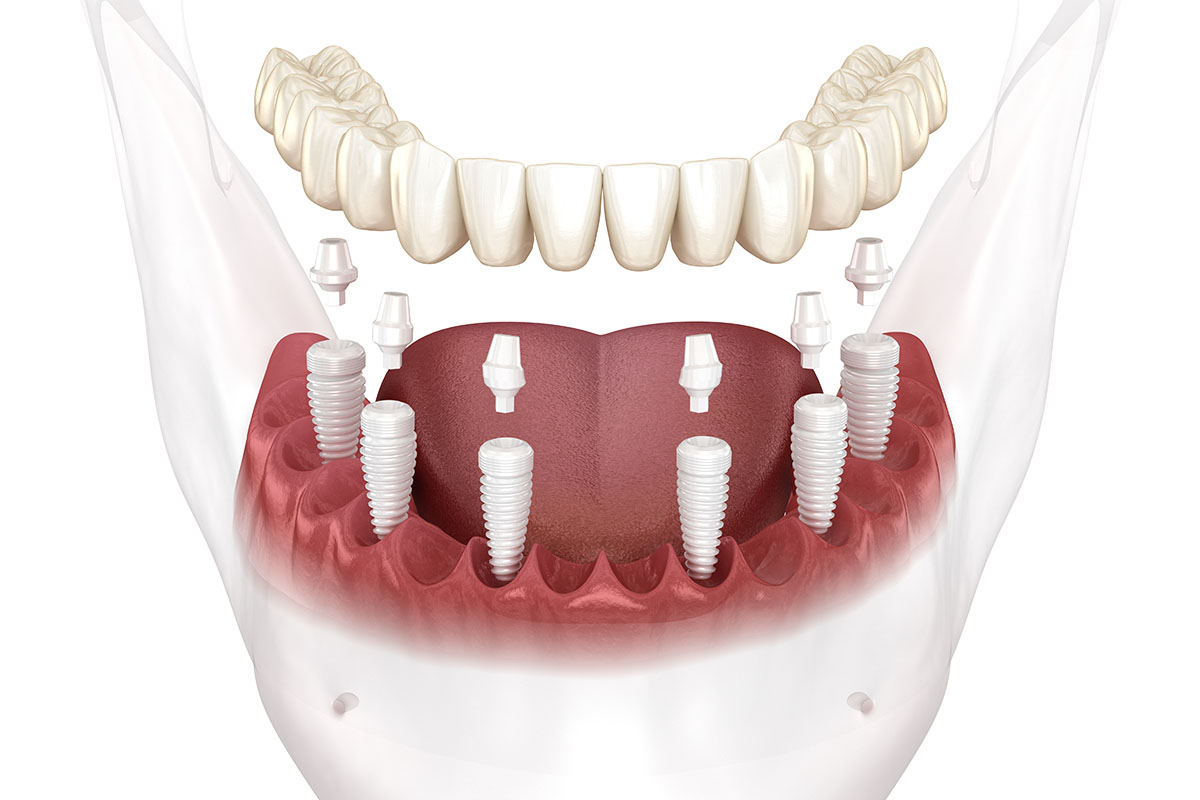 Full Mouth All-on-6 Zirconia Dental Implants Metal-Free Full Mouth Implants