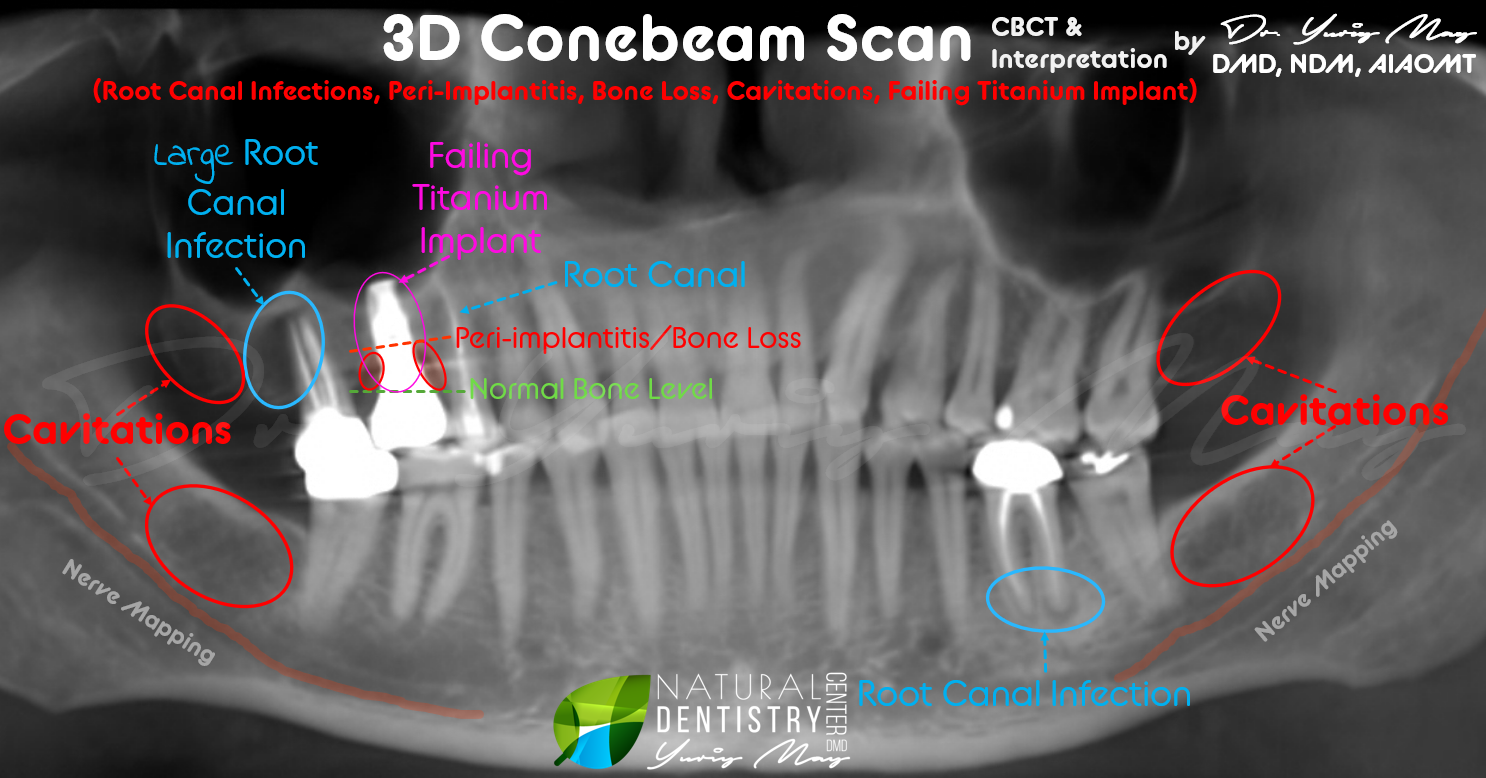 Dental cavitations treatment jawbone infection CBCT scan and biological surgery by Dr. May Connecticut
