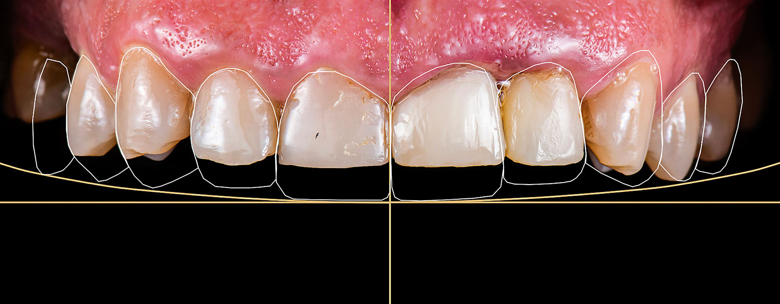 digital planning for full smile case
