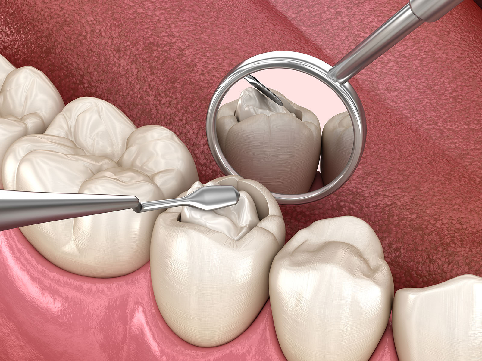 Decayed tooth restoration with composite filling. Medically accu