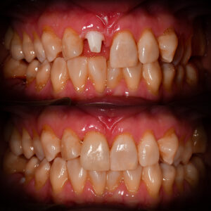 Front Tooth Ceramic Implant Before & After Best Ceramic Implant Dentist USA Dr. May