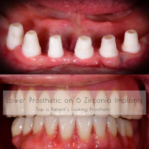 Full Mouth Ceramic Implants Before & After All-on-X Ceramic Implants Metal Free Implants Full Mouth