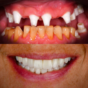 Full Mouth Zirconia Implants Before & After All-on-X Ceramic Implants Metal-Free Implants Full Mouth