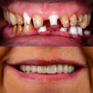 Front Tooth Ceramic Implant Before & After Top Ceramic Implant Dentist USA Dr. May Full Mouth Ceramic Implants