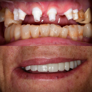 Front Tooth Implants Before & After Zirconia Front Tooth Implants Best Ceramic Implant Dentist USA