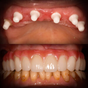Full Mouth Ceramic Implants Before & After All-on-X Ceramic Implants Metal Free Implants Full Mouth
