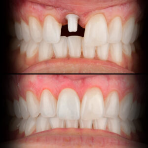 Zirconia Implant Before & After - Best Zirconia Implant Dentist USA Dr. May