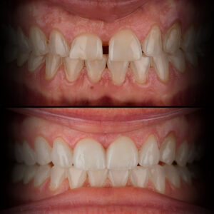 Veneers Before & After Best Biological Dentist USA