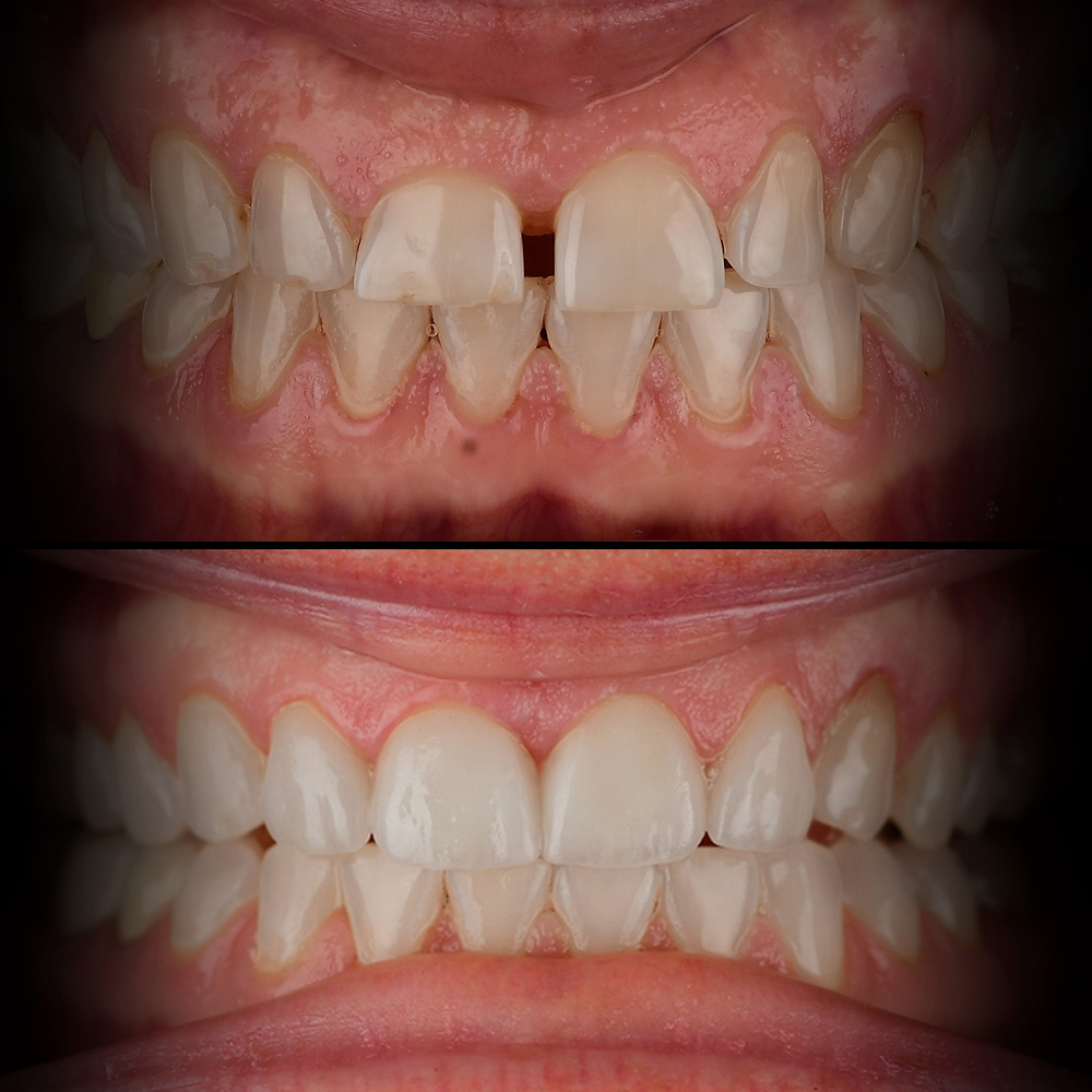 Veneers Before & After Best Biological Dentist USA