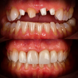Front Tooth Ceramic Implant Before and After Dr. May Best Ceramic Implant Dentist
