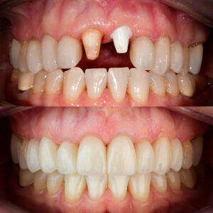 Front Tooth Ceramic Implant Before & After Dr. May Best Ceramic Implant Dentist