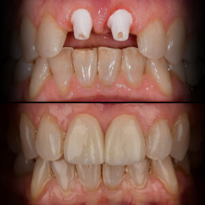Front Tooth Ceramic Implant Before & After - Best Ceramic Implant Dentist USA Dr. May