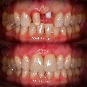 Front Tooth Ceramic Implant Before & After Top Ceramic Implant Dentist USA Dr. May