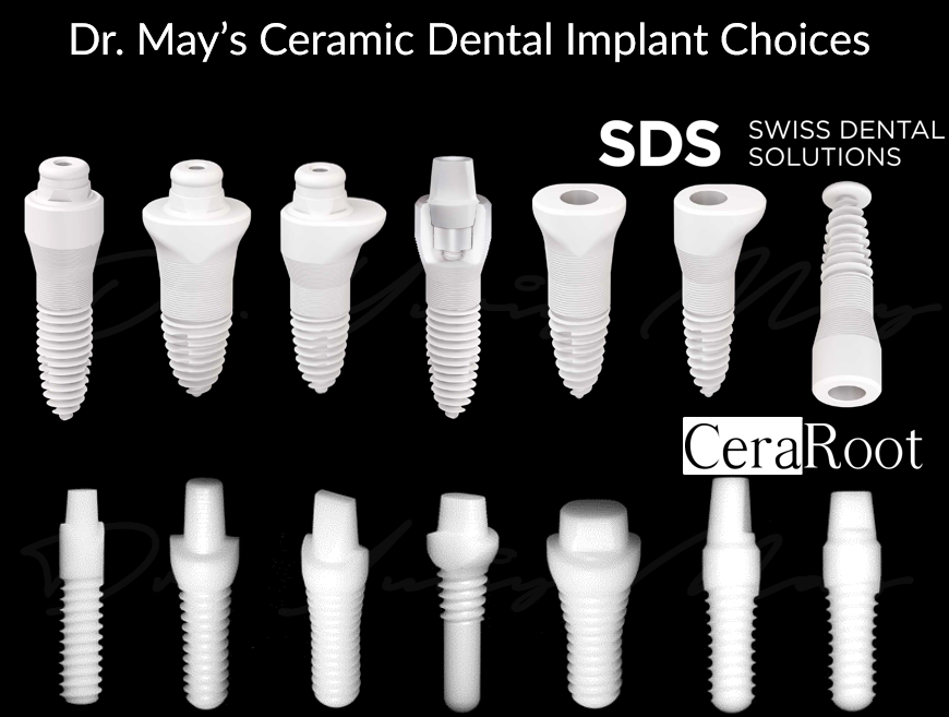 Dr. May Top Ceramic Implant Dentist in USA uses only SDS and Ceraroot Implants