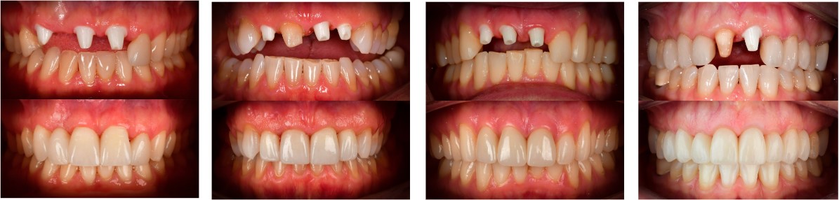 Best Front Tooth Ceramic Implant Before and After by Best Ceramic Implant Dentist Dr. May Natural Dentistry