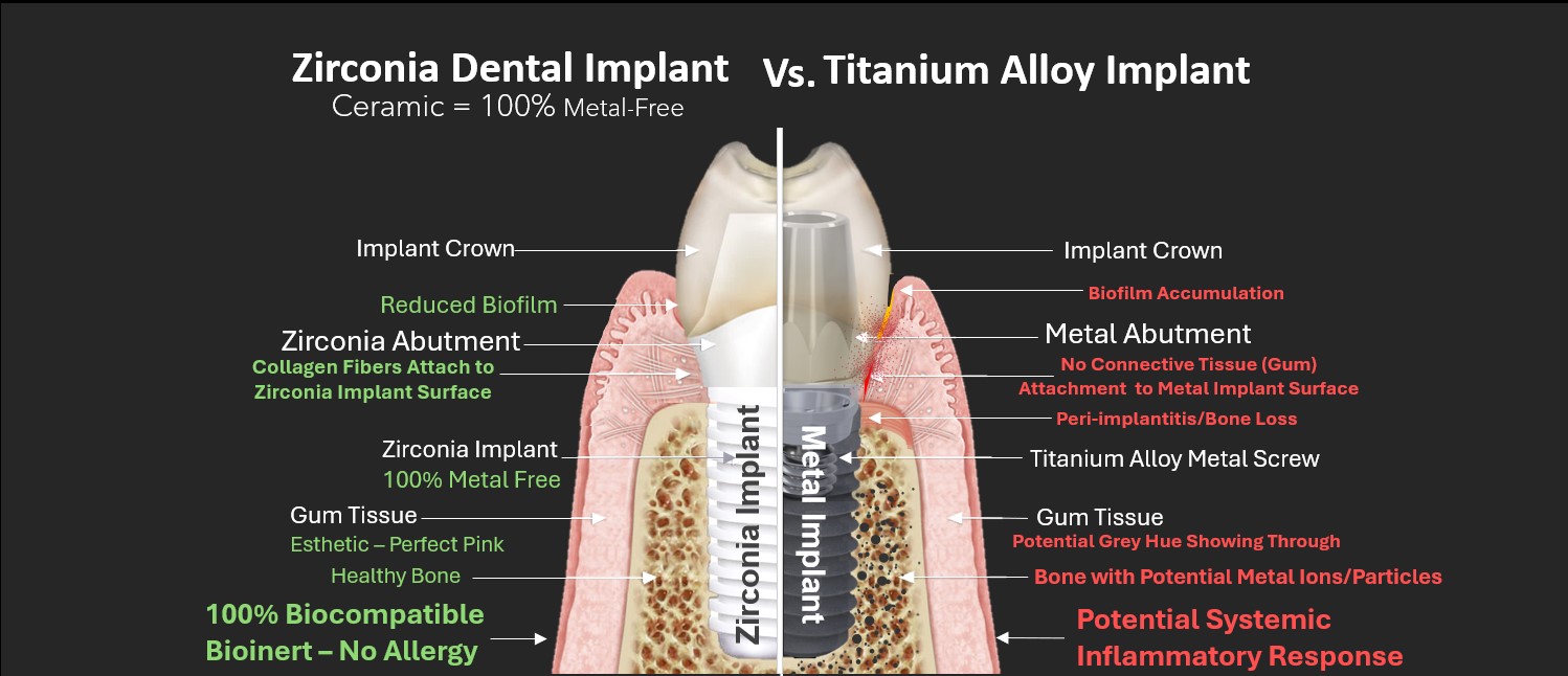 Zirconia Implant Advantages over Metal Implants by Dr. May Leading Expert on Zirconia Implants