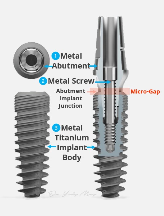 Titanium Implant 3 Parts Micro Gap Identifed Titanium vs Zirconia Implant