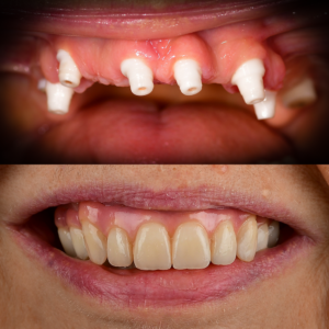 Ceramic Full Arch Before and After