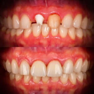 Front Tooth Implant Zirconia Dental Implant Before and After Front Tooth Implant Before and After Dr. May Best Ceramic Implant Dentist