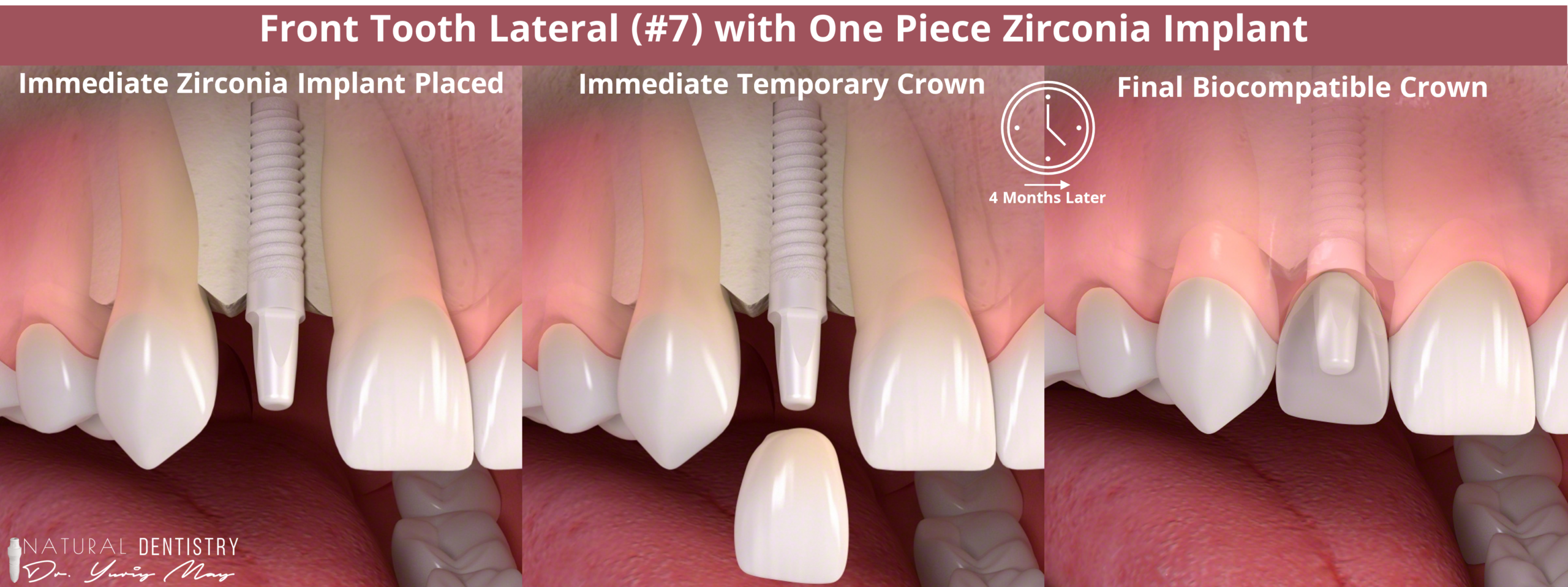 Front Tooth Implant - Immediate Zirconia Front Tooth Implant Process by Best Zirconia Implant Dentist Dr. May