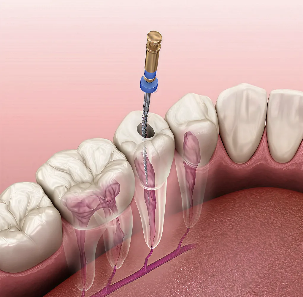 root-canal-image
