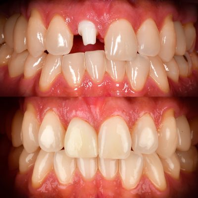 Zirconia Implant Front Tooth Before & After Best Ceramic Implant Dentist Dr. May