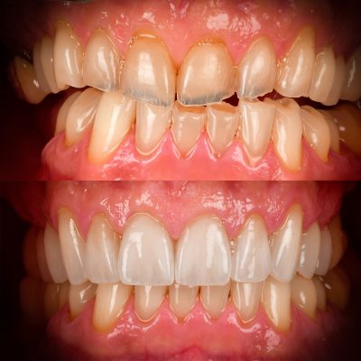 Veneers Smile Makeover Before After Biological Dentistry Cosmetic Dentistry