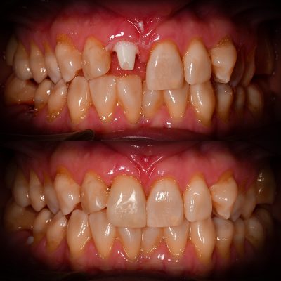 Front Tooth Ceramic Implant Before & After Best Ceramic Implant Dentist USA Dr. May