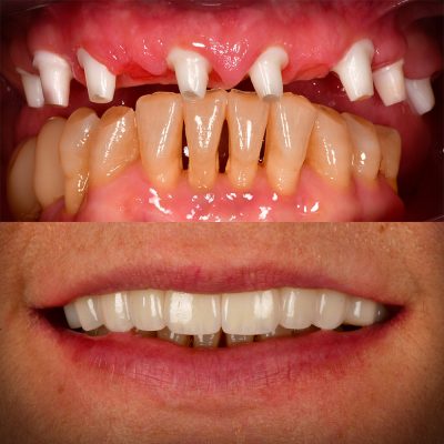 Full Mouth Ceramic Implants Before & After All-on-X Ceramic Implants Metal Free Implants Full Mouth