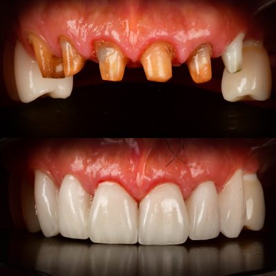 Full Mouth Ceramic Implants Before & After Best Ceramic Implants Dentist USA Metal-Free Implants Full Mouth