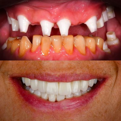 Full Mouth Zirconia Implants Before & After All-on-X Ceramic Implants Metal-Free Implants Full Mouth