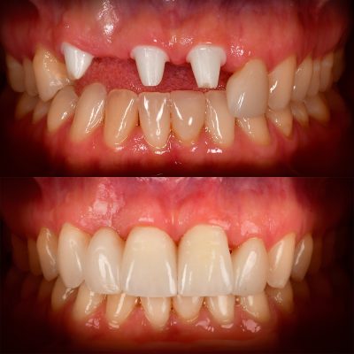 10 Front Tooth Ceramic Implant Before & After