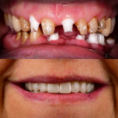 Front Tooth Ceramic Implant Before & After Top Ceramic Implant Dentist USA Dr. May Full Mouth Ceramic Implants