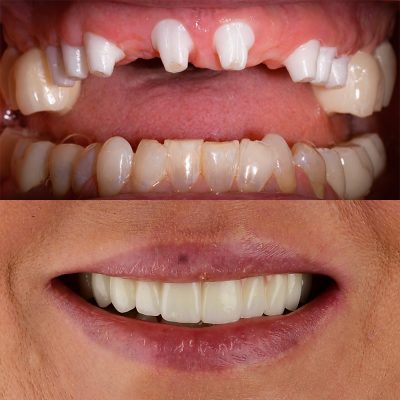 Full Mouth Ceramic Implants Before & After All-on-X Ceramic Implants Metal-Free Implants Full Mouth