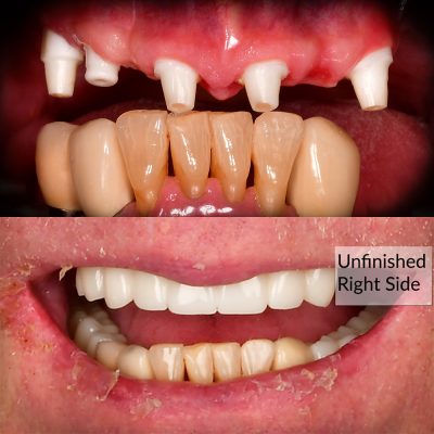 Full Mouth Ceramic Implants Before & After All-on-X Ceramic Implants Metal-Free Implants Full Mouth