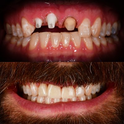 Front Tooth Ceramic Implant Before & After Top Ceramic Implant Dentist USA Dr. May