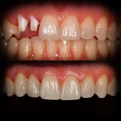 15 Front Tooth Ceramic Implant Before & After