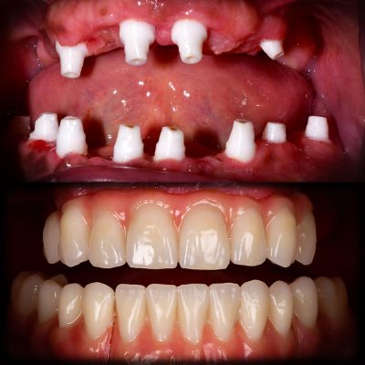 Full Mouth Ceramic Implants Before & After All-on-X Ceramic Implants Metal Free Implants Full Mouth