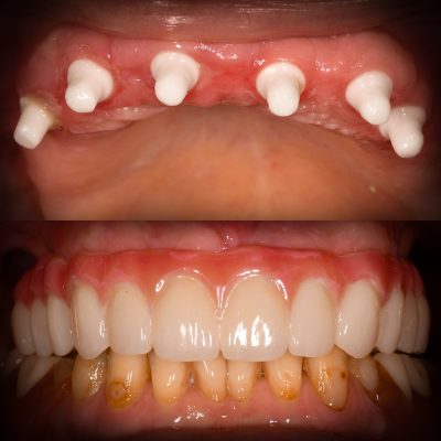 Full Mouth Ceramic Implants Before & After All-on-X Ceramic Implants Metal Free Implants Full Mouth