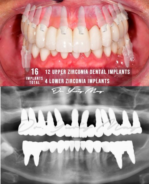 Zirconia Implants Full Mouth All-on-X Upper Arch Ceramic Implant Best Zirconia Implant Dentist Dr. May
