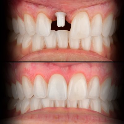 Zirconia Implant Before & After - Best Zirconia Implant Dentist USA Dr. May