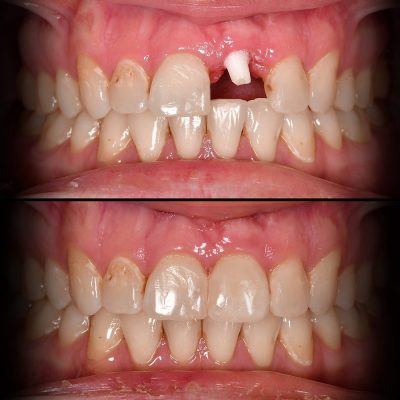 Front Tooth Ceramic Implant Before & After Top Ceramic Implant Dentist USA Dr. May