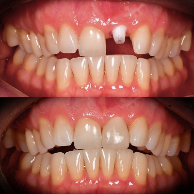 Front Tooth Ceramic Implant Before & After Top Ceramic Implant Dentist USA Dr. May