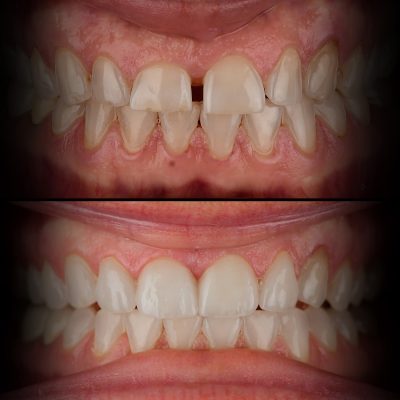 Veneers Before & After Best Biological Dentist USA