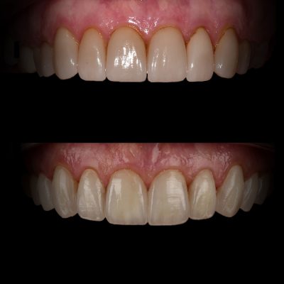 Veneers Before & After Best Biological Dentist USA