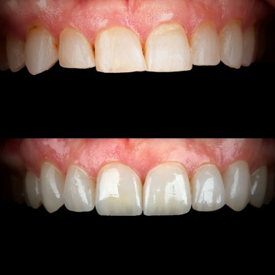 Veneers Before & After Best Biological Cosmetic Dentist USA