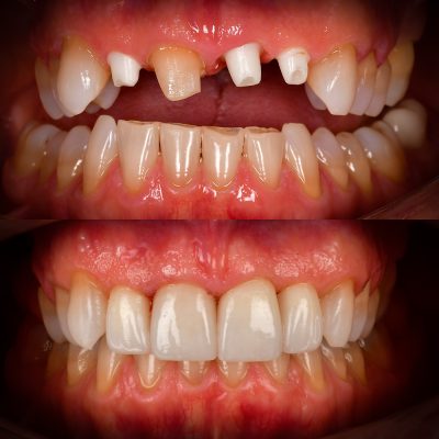 Front Tooth Ceramic Implant Before and After Dr. May Best Ceramic Implant Dentist