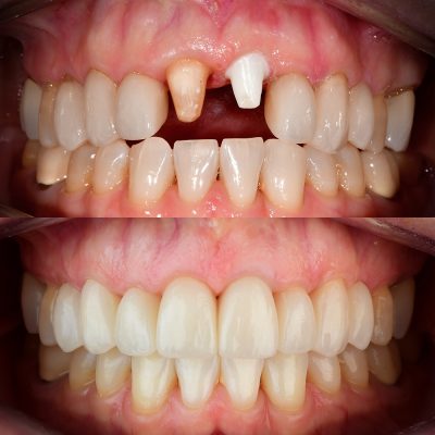 Front Tooth Ceramic Implant Before & After Dr. May Best Ceramic Implant Dentist